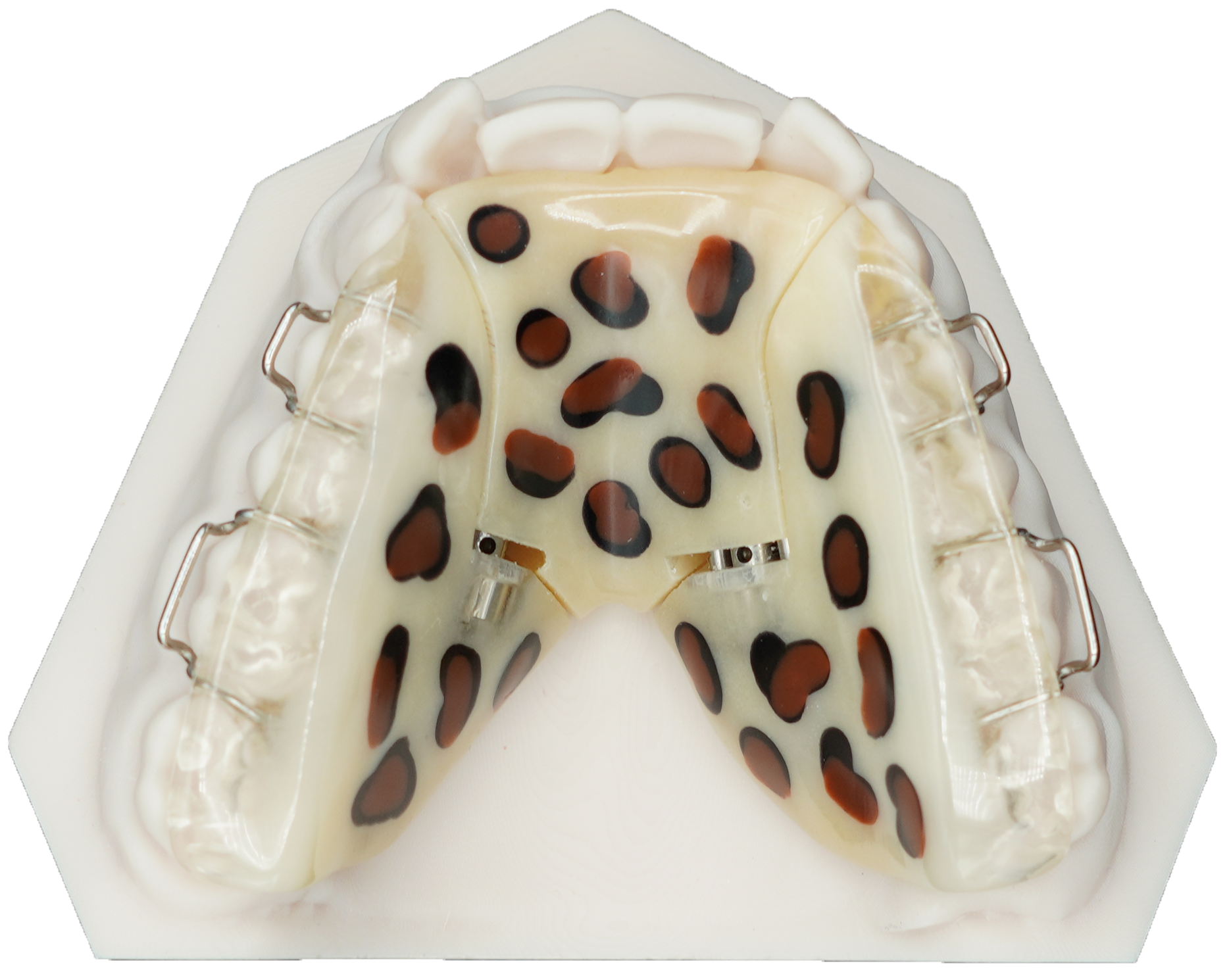 Sagittal Appliance Upper